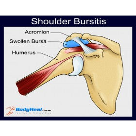 shoulder bursitis injury