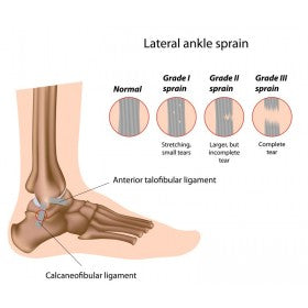 Types of ankle sprains